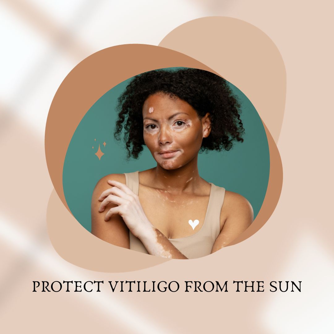 How can I protect my vitiligo from the sun?